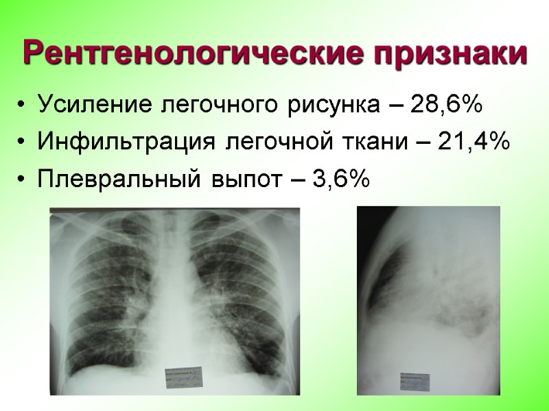 Рентгенологические признаки Усиление легочного рисунка – 28,6% Инфильтрация легочной ткани – 21,4% Плевральный выпот